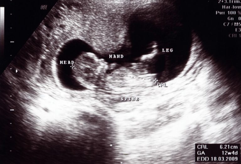 गर्भावस्था के 12 वें सप्ताह का अल्ट्रासाउंड