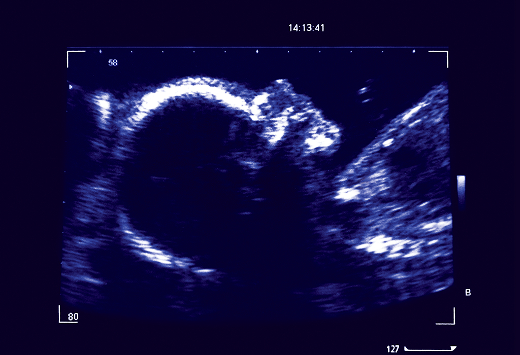 गर्भावस्था के 26वें सप्ताह का अल्ट्रासाउंड