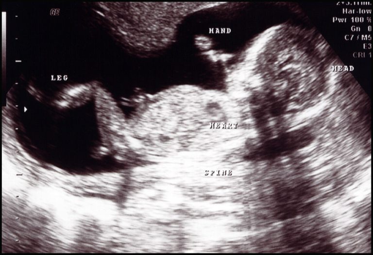 Week 17 17 Weeks Pregnant: Symptoms, Baby Size, Body Changes & more