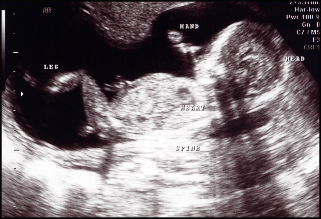 गर्भावस्था के17वें सप्ताह का अल्ट्रासाउंड