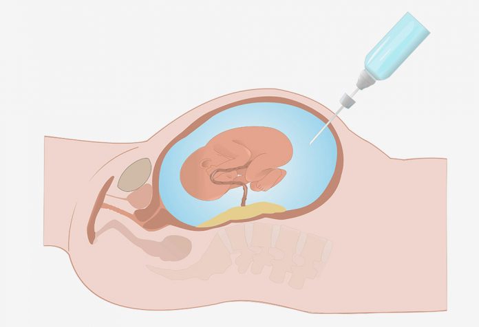 प्रेगनेंसी में एम्नियोसेंटेसिस द्रव परीक्षण (जांच)