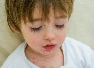 বাচ্চাদের চিকেন পক্স বাচ্চাদের চিকেন পক্স