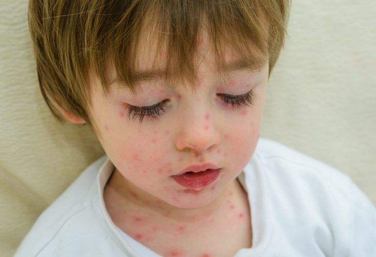 Chickenpox in Babies & Children
