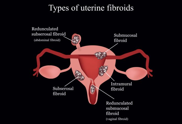 What Are The Causes Of Uterine Fibroids During Pregnancy