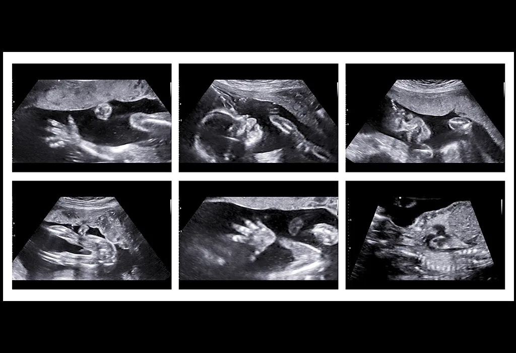 Ultrasound Scan at 20 Weeks