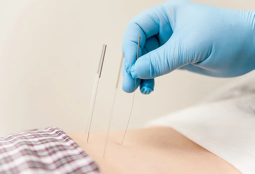 Treatment of PGP - Accupuncture