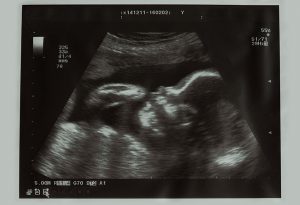 4 Weeks Ultrasound
