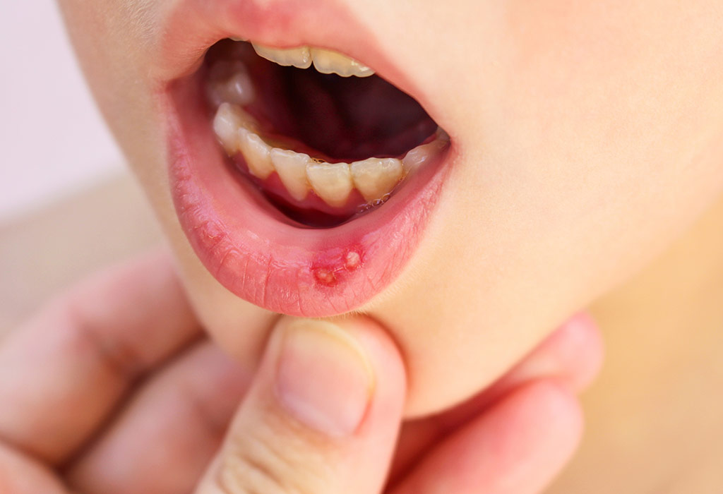 बच्चों के मुंह में छाले होने के लक्षण 
