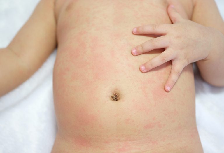 Heat Rash in Babies- Causes, Treatment and Home Remedies