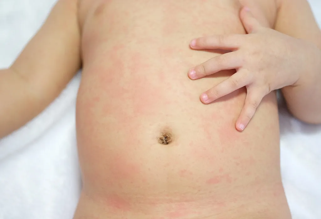 How to get rid of heat rash and prickly heat in children and