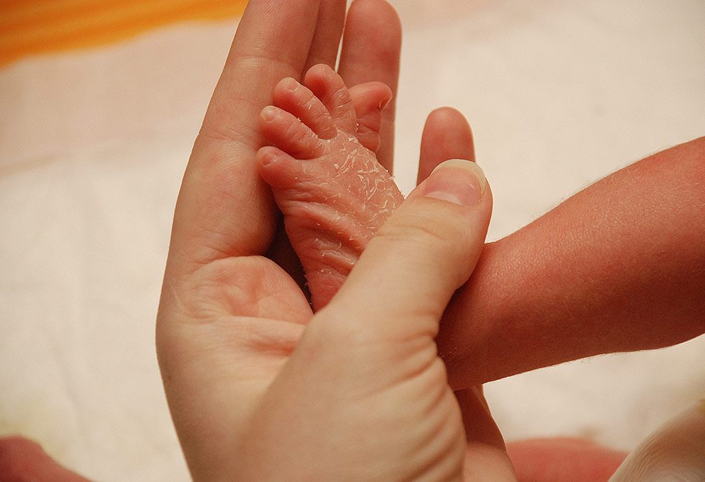 zebra Nyttig Tilintetgøre Dry Skin in Infants – Reasons & Home Remedies
