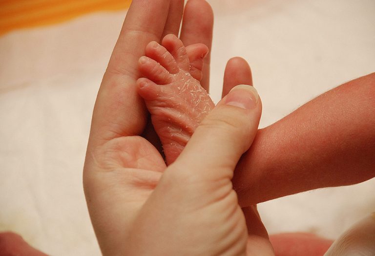 Dry Skin in Babies