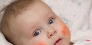 शिशुओं में एक्जिमा - कारण, लक्षण और उपचार