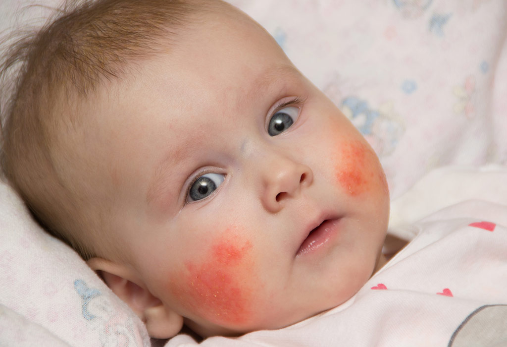 eczema causes in babies)