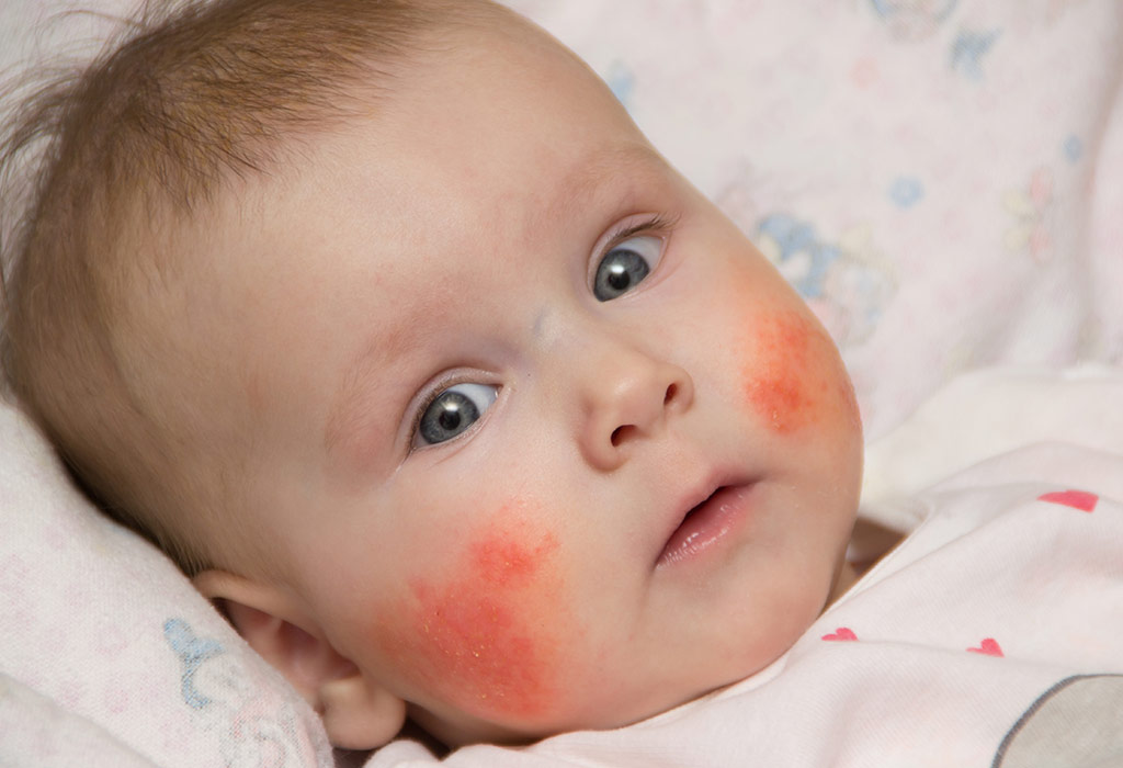 Eczema rash on baby face treatment