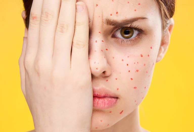 Chickenpox during Pregnancy
