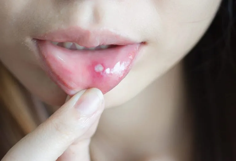 Mouth Ulcers During Pregnancy