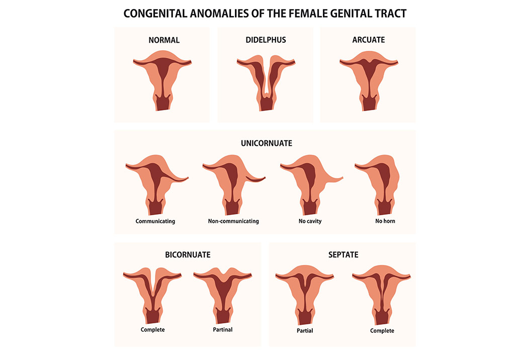 Abnormalities of the Uterus in Pregnancy – Types, Risks & Treatment