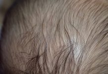बच्चों में बाल झड़ने की बीमारी एलोपेसिया एरीटा