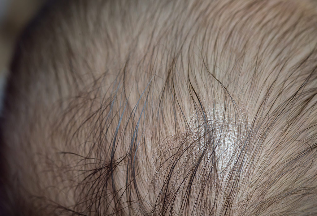 एलोपेसिया एरीटा - बच्चों के बहुत ज्यादा बाल झड़ने के कारण, लक्षण और इलाज |  Baccho Mein Alopecia Areata - Baal Jhadne Ke Karan, Lakshan Aur Ilaaj