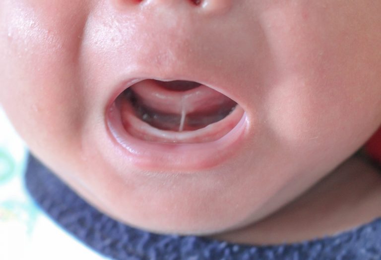 Tongue-Tie in Newborn Babies