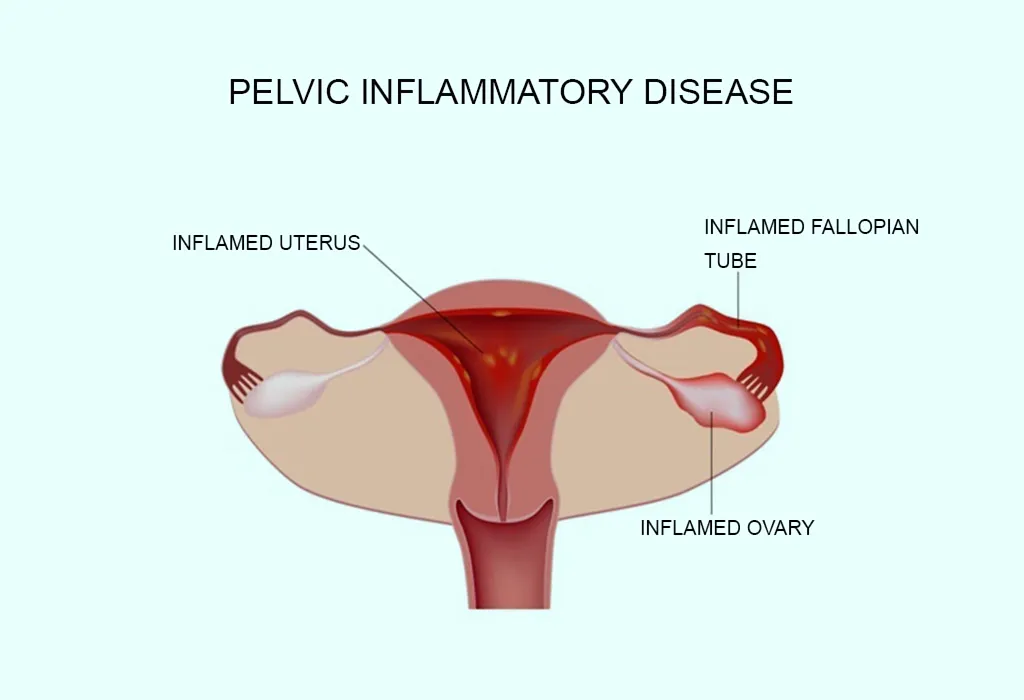 Do Cramps But No Period Mean Pregnancy? Experts Explain