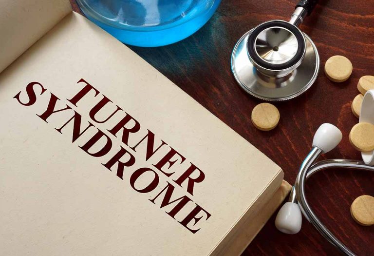 Turner Syndrome – Symptoms, Causes & Treatment