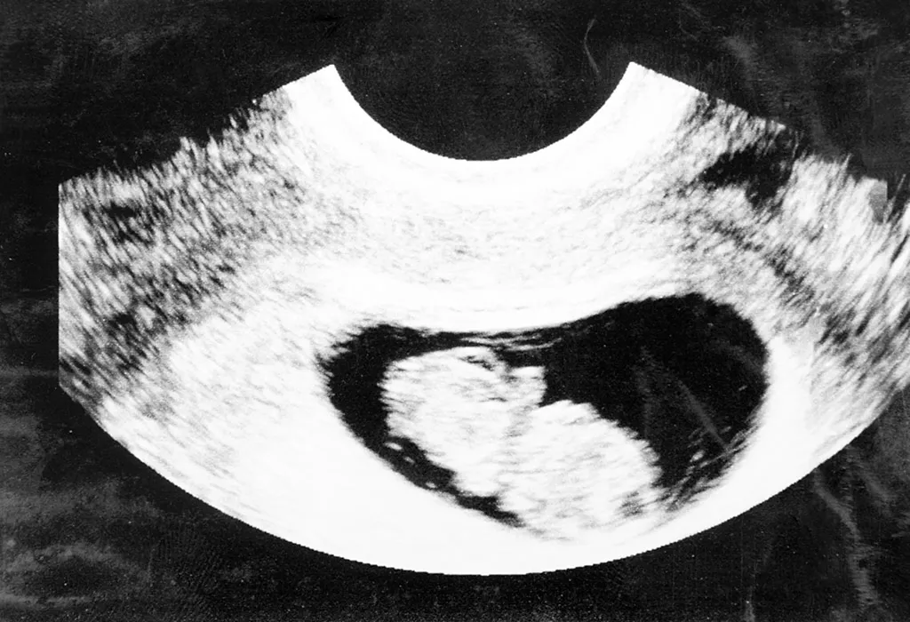 9 weeks fetus ultrasound