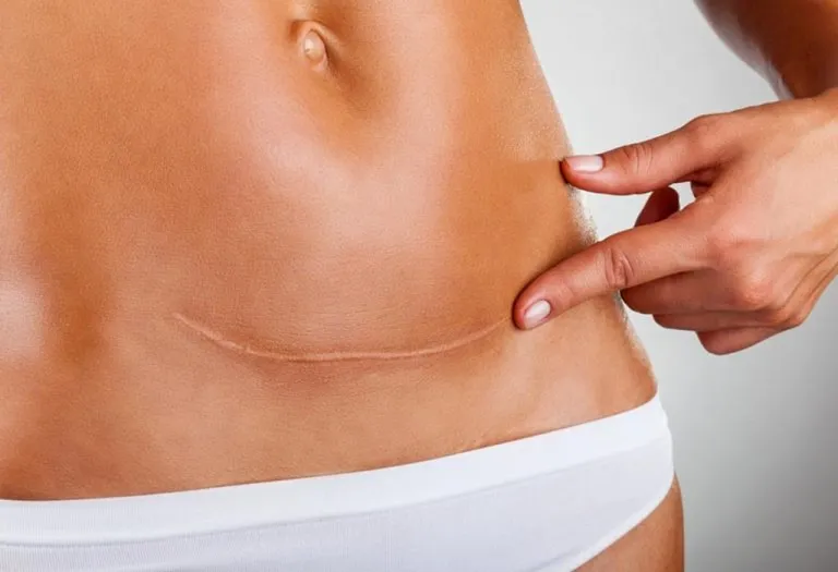 C-Section Scars - An Overview