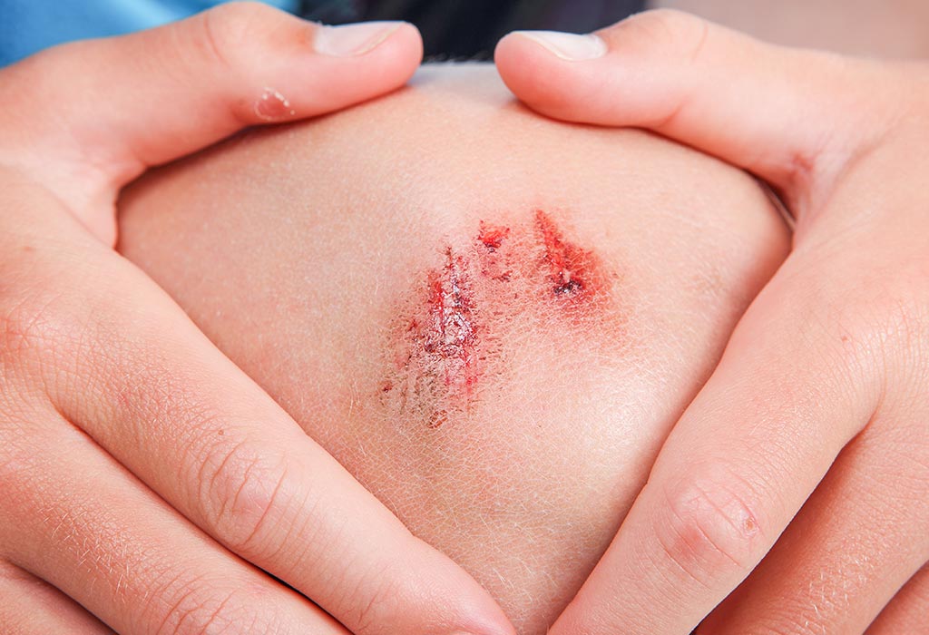 Cuts and Scrapes Cuts and Scrapes