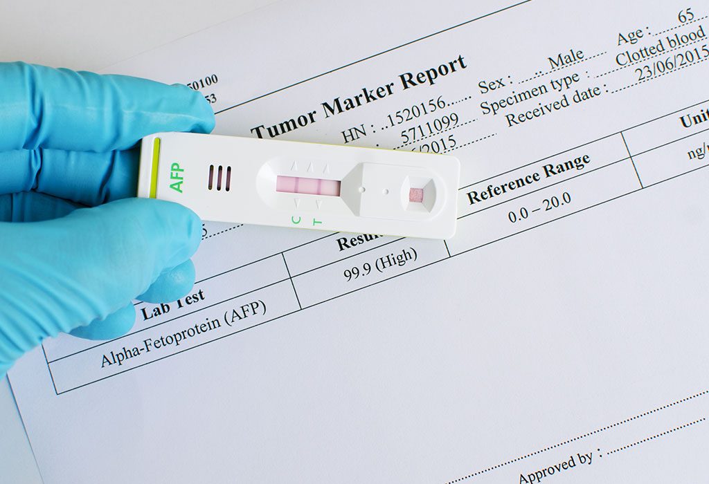 Alpha Fetoprotein (AFP) Test During Pregnancy