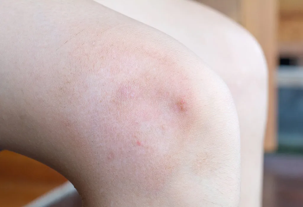 Symptoms of Knee Pain in Kids