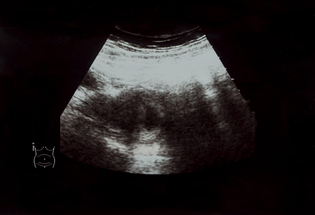 गर्भावस्था के छठे सप्ताह का अल्ट्रासाउंड
