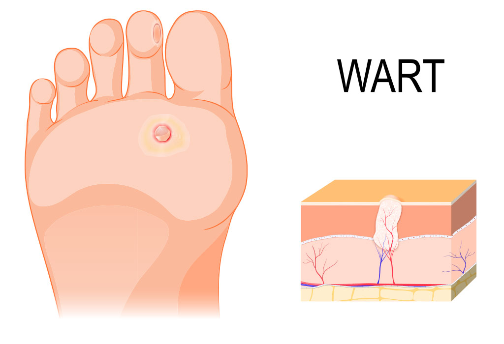 foot warts during pregnancy