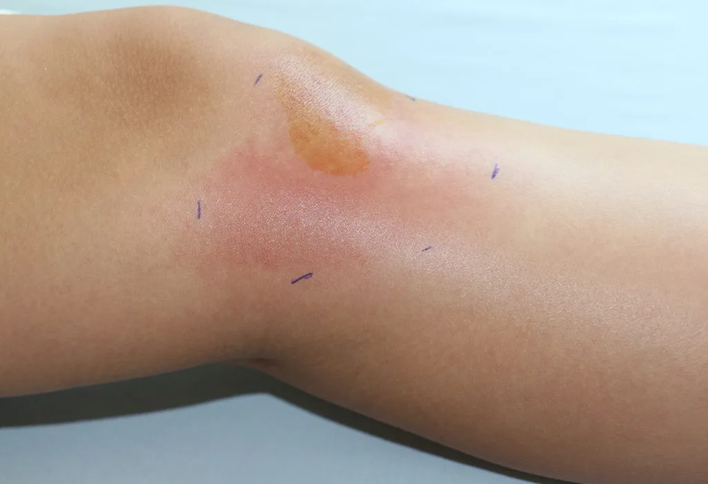 Causes of Knee Pain in Children