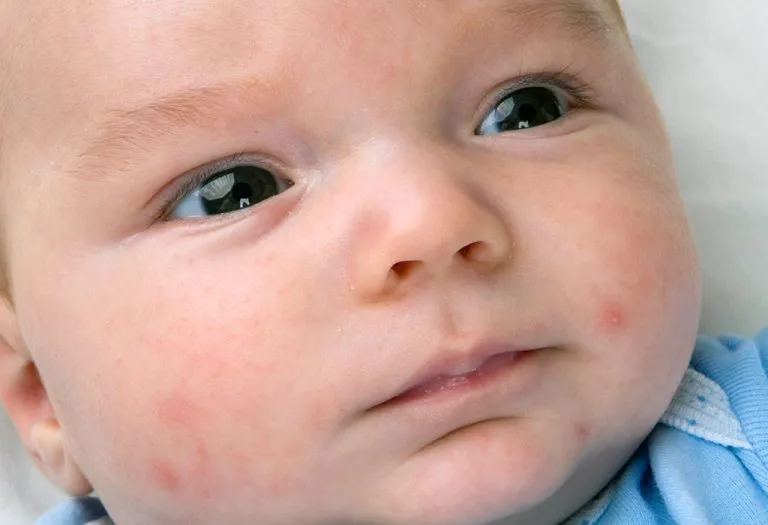 Baby Acne – Causes, Symptoms & Treatment