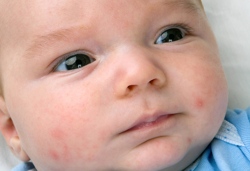 Pimples On Baby Face Reasons Signs Home Remedies