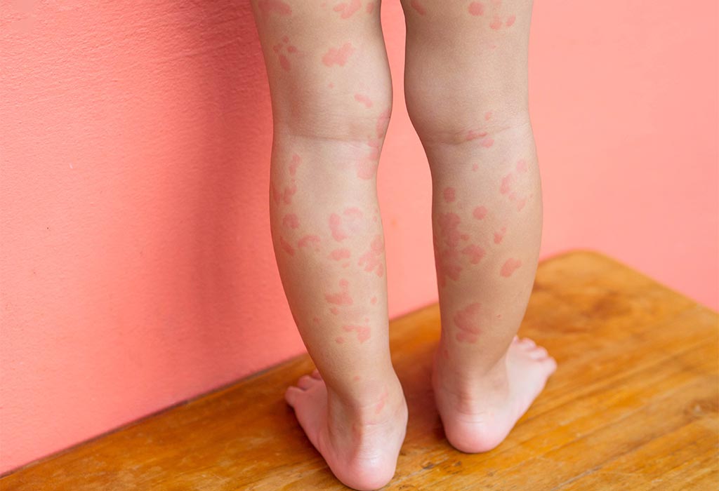 Hives On Toddler Legs