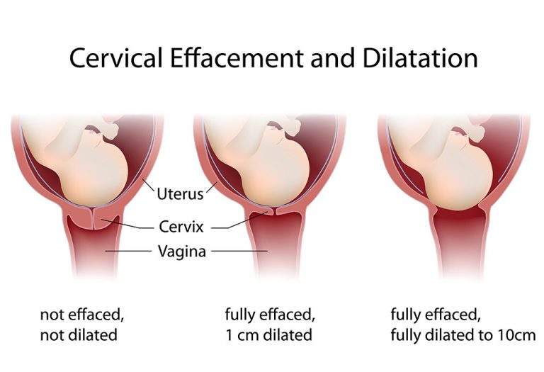 Cervix Dilation During Labour and Birth