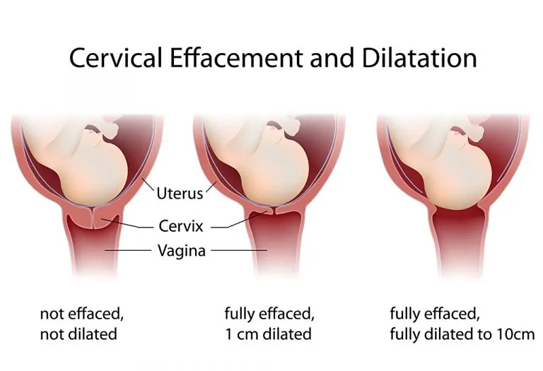 Cervix Dilation During Labour and Childbirth