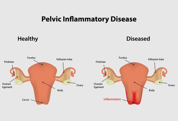 Pelvic Inflammatory Disease (PID): Causes, Symptoms & Treatment