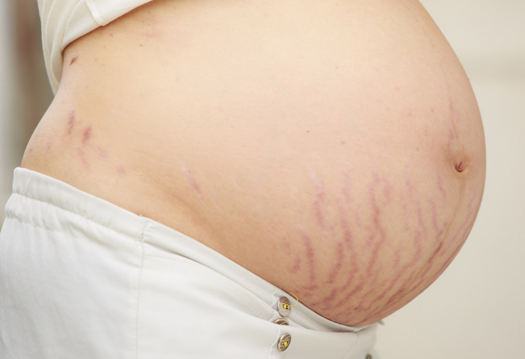 Stretch Marks 8 Months Pregnant