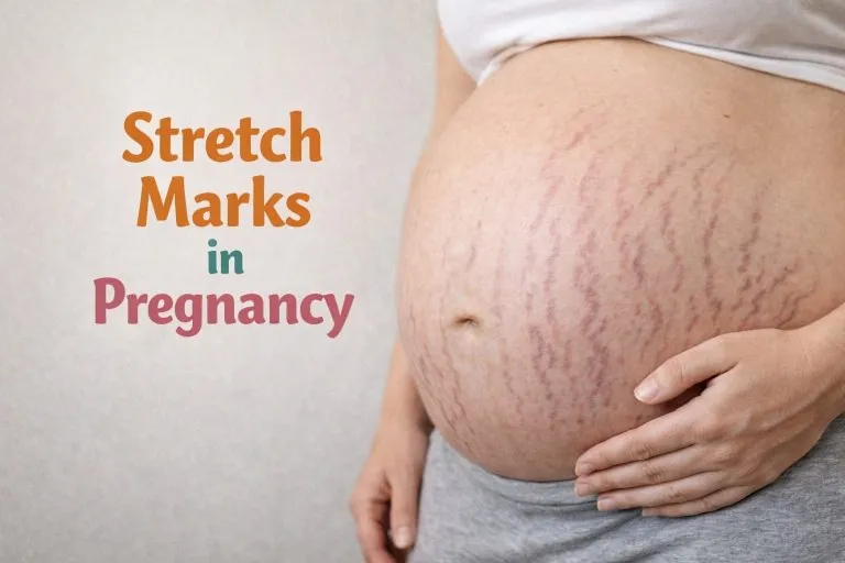 Stretch Marks in Pregnancy - Causes, Prevention, and Home Remedies