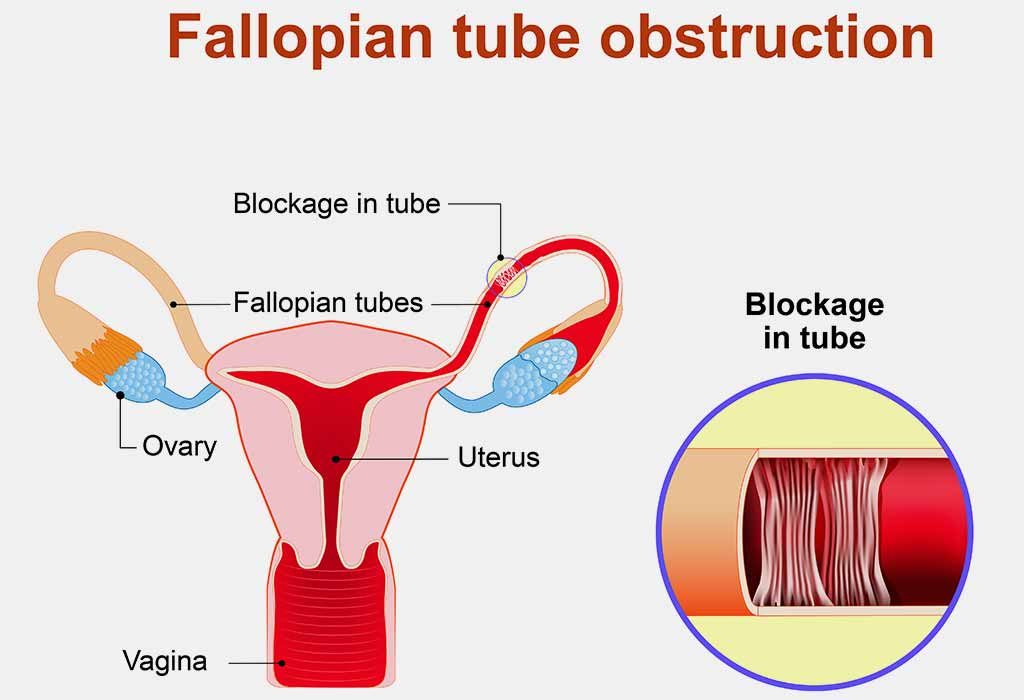 Fallopian Tube Factors