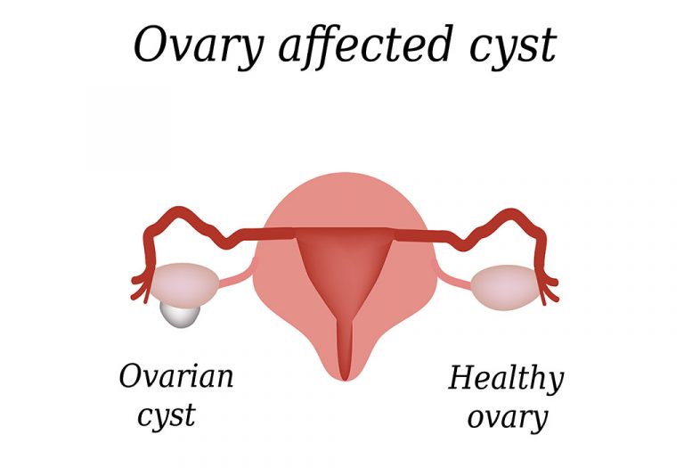 ovarian cyst spotting between periods