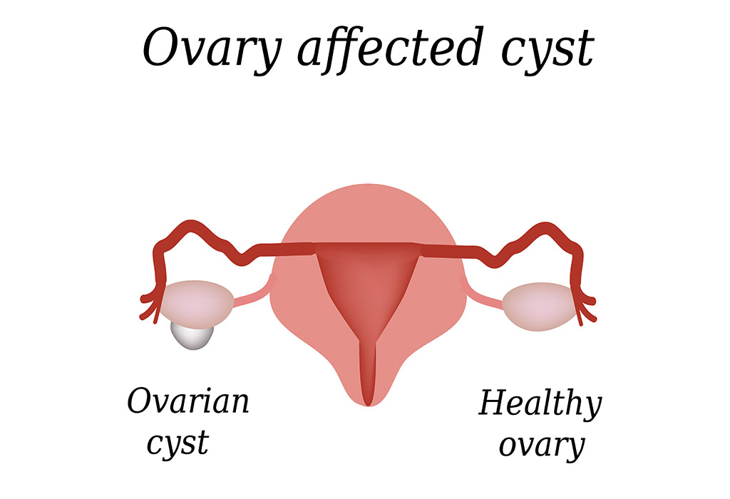 ovarian cyst spotting between periods