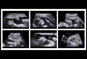 Fetus ultrasound