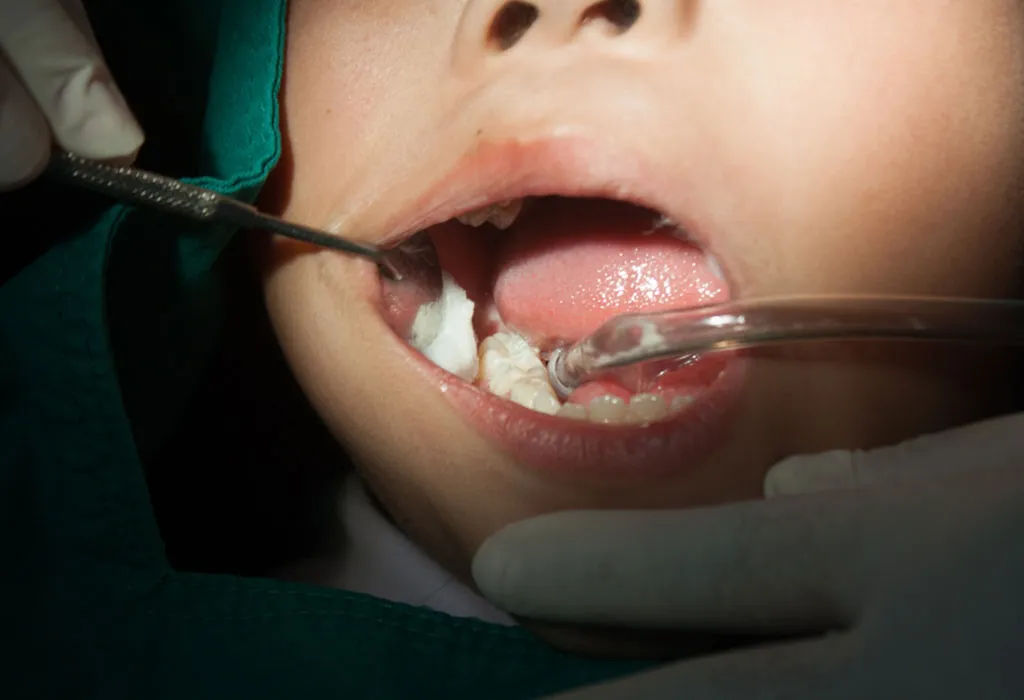 Child teeth filling
