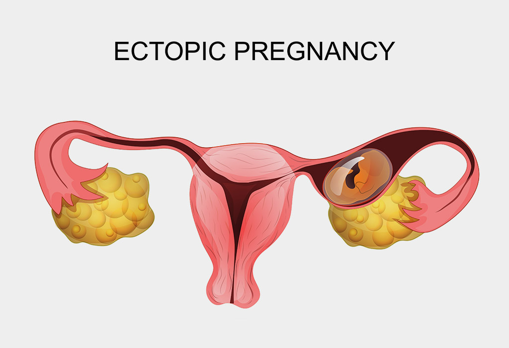 Ectopic Pregnancy Ectopic Pregnancy