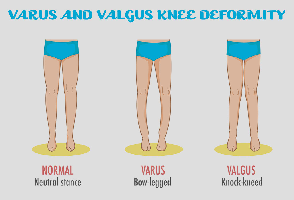 Bowed Legs In Infants Reasons Signs Diagnosis Treatment